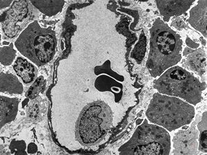 celiakia- plasmocellular infiltrationof lamina propria